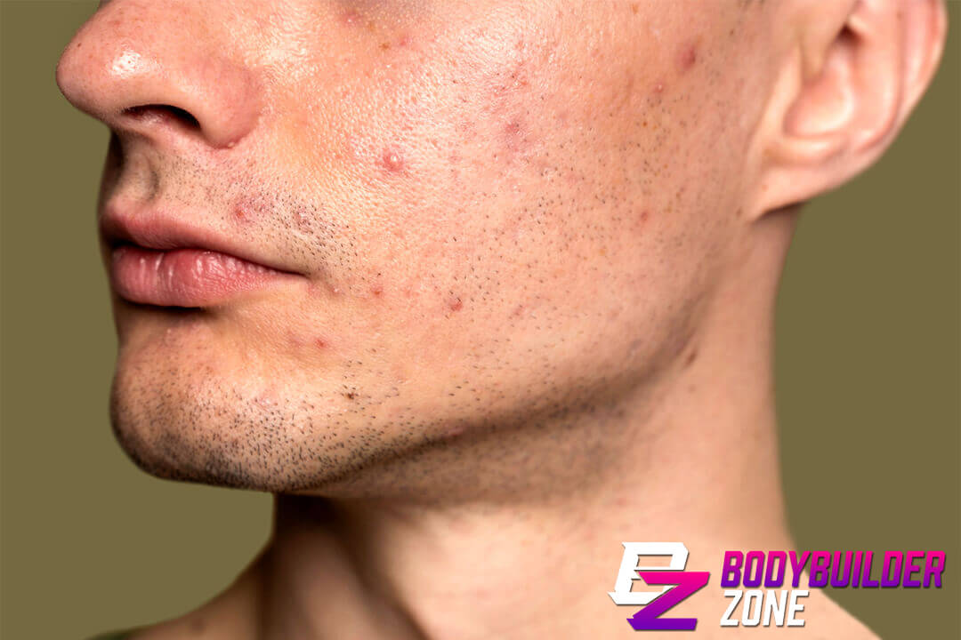Common Side Effects Acne